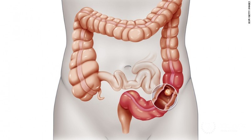 Colorectal cancer