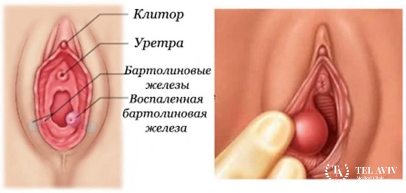 Киста бартолиновой железы