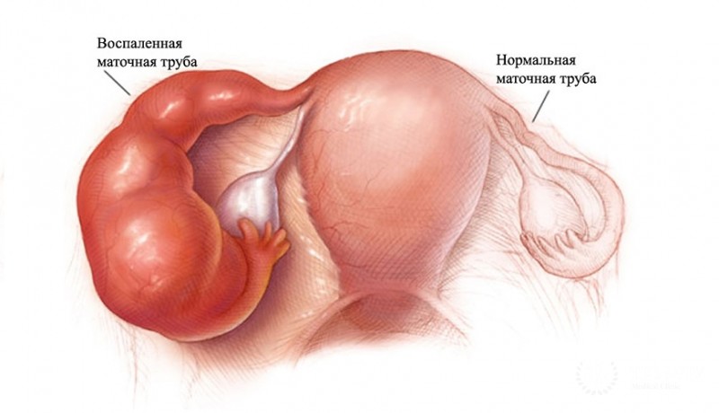 Онкология маточных труб