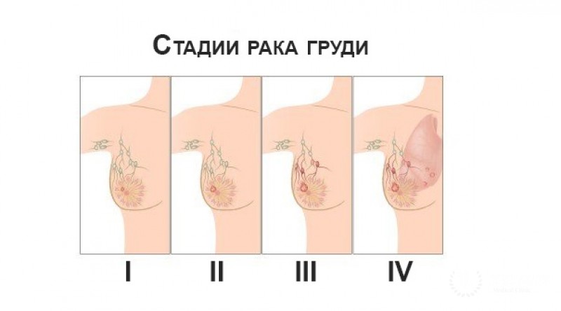 Рак с признаками эндокринного новообразования