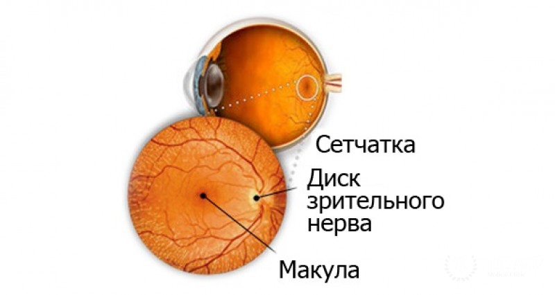 Низкотемпературная (криогенная) терапия при глиоме сетчатки