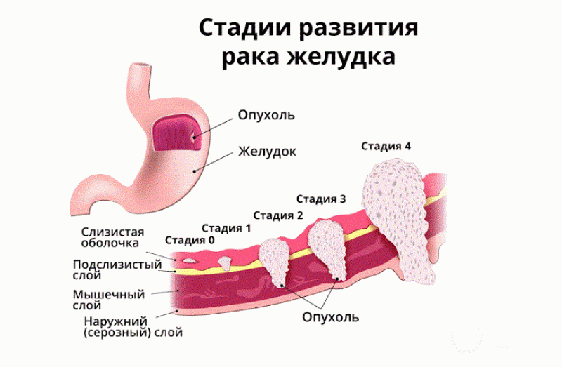 Чем опасен недифференцированный рак желудка?