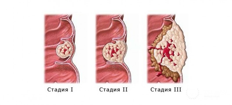 Плоскоклеточный рак прямой кишки - информация про новообразование