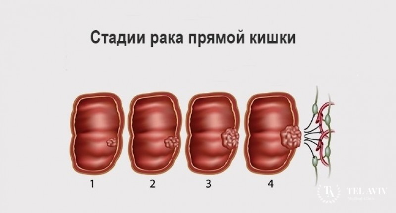 Железисто-плоскоклеточная карцинома прямой кишки - причины заболевания