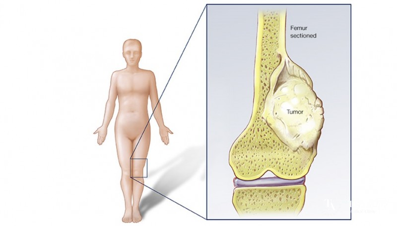 Osteosarcoma in children - full information