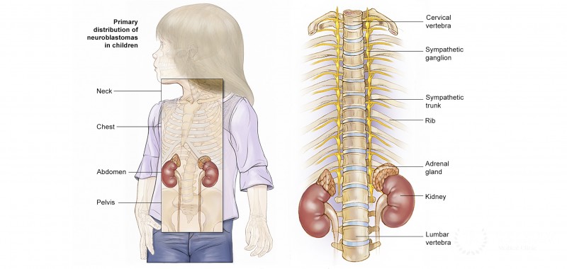 Neuroblastoma in children