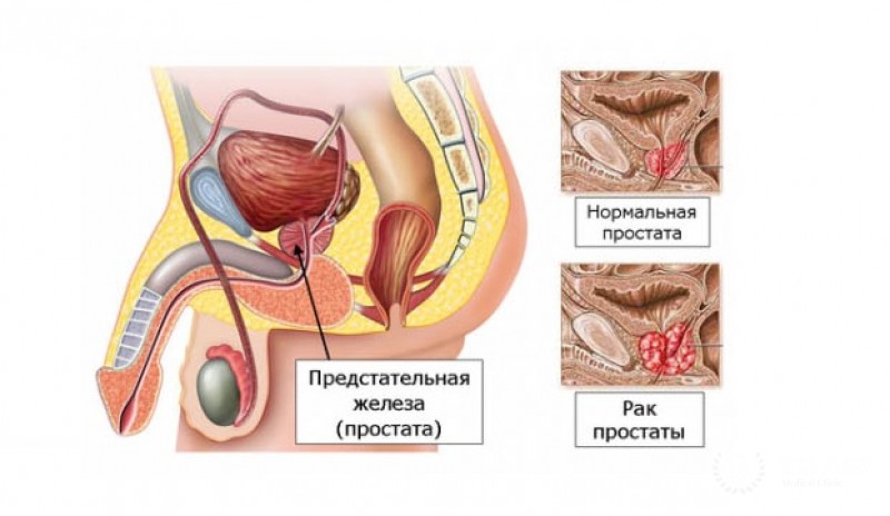 Онкология предстательной железы