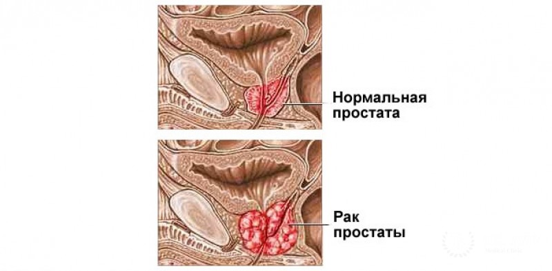 Скиррозный рак предстательной железы