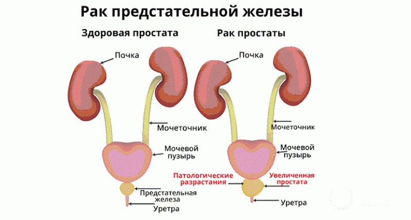 Саркома предстательной железы