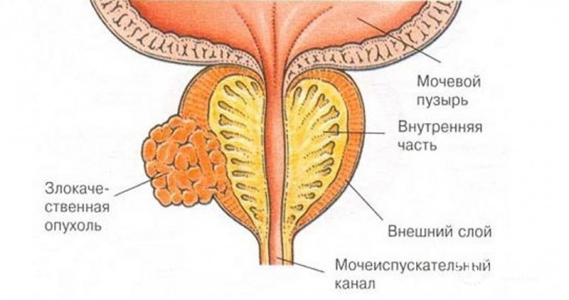 Интраэпителиальная неоплазия предстательной железы