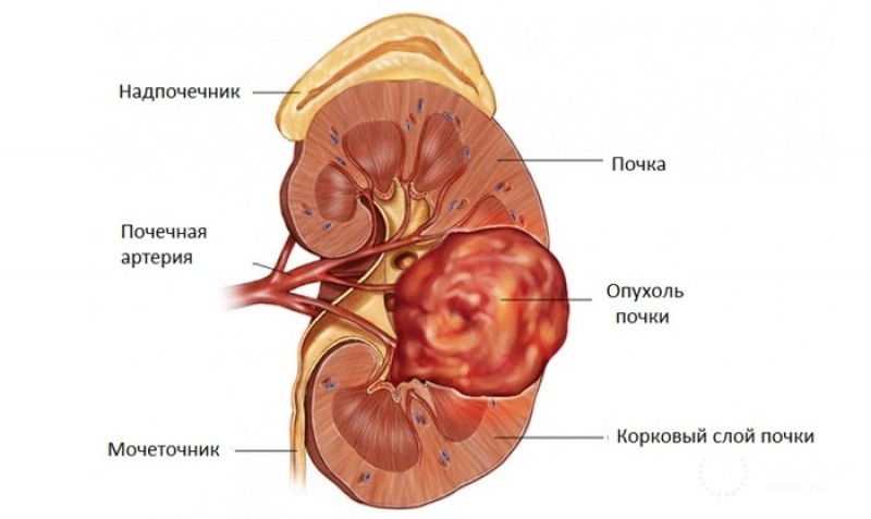 Онкоцитома почки