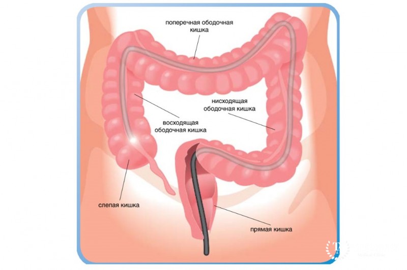 Колоноскопия - качественный подход к диагностики