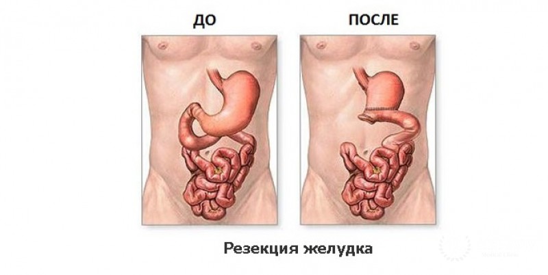 Гастрэктомия - современный подход в борьбе с раком