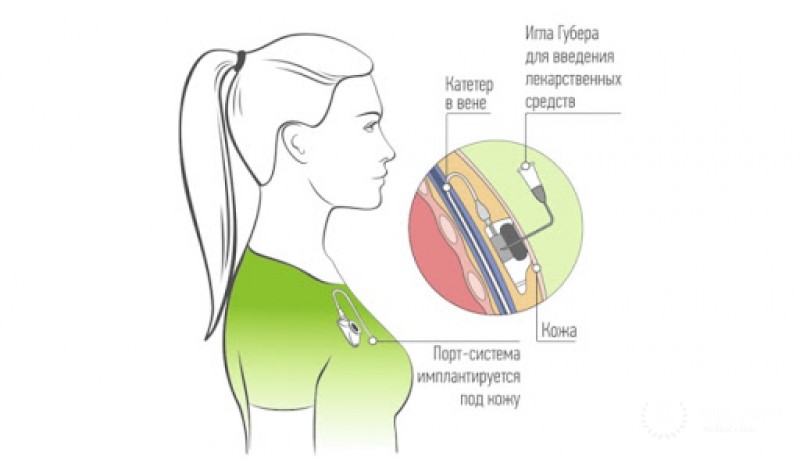 Операция для введения химиотерапии - что это?