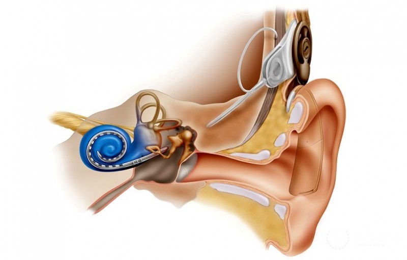 Кохлеарная имплантация: принцип работы устройства, противопоказания к проведению процедуры