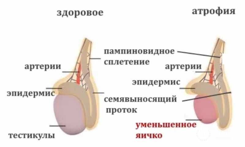 Атрофия яичка