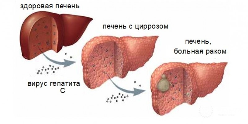 Гепатоцеллюлярная карцинома печени: причины появления и диагностика заболевания