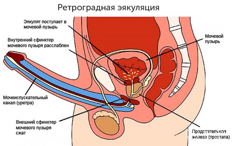 Ретроградная эякуляция