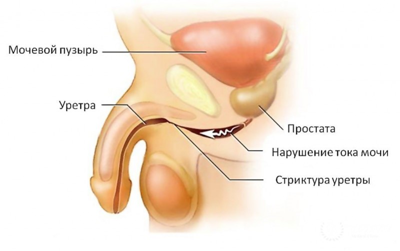 Стриктура уретры