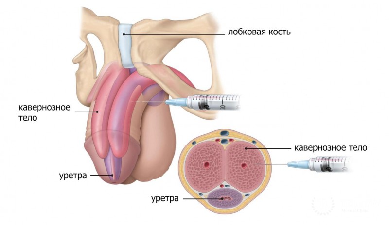 Лечение PDE5i