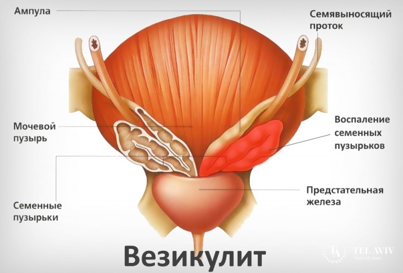 Везикулит