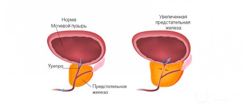 Доброкачественная гиперплазия предстательной железы