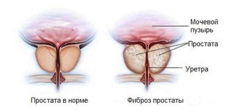 Фиброз простаты