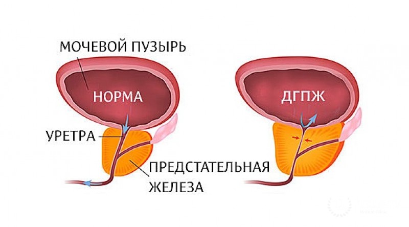 Доброкачественная гиперплазия предстательной железы