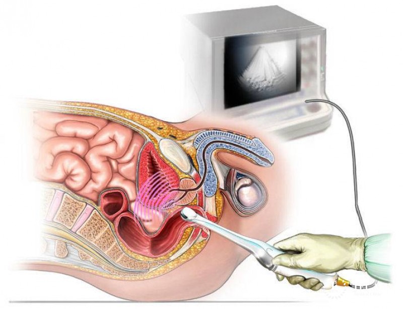 Трансректальное УЗИ(TRUS)