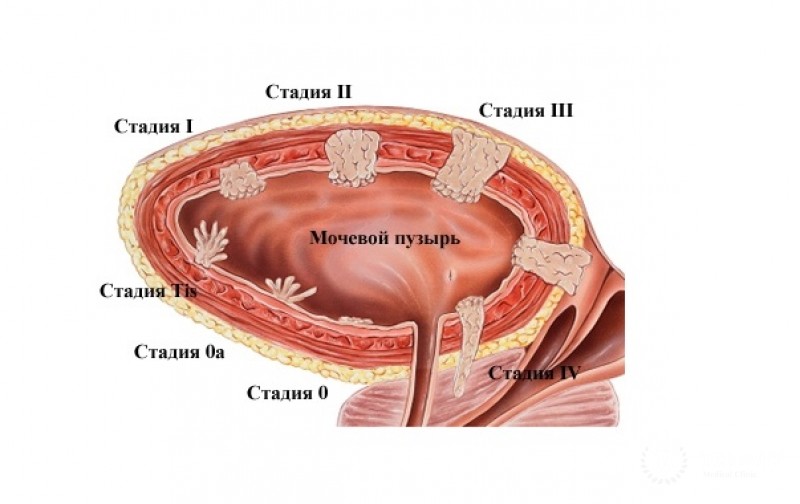 Карцинома мочевого пузыря: симптомы, профилактика