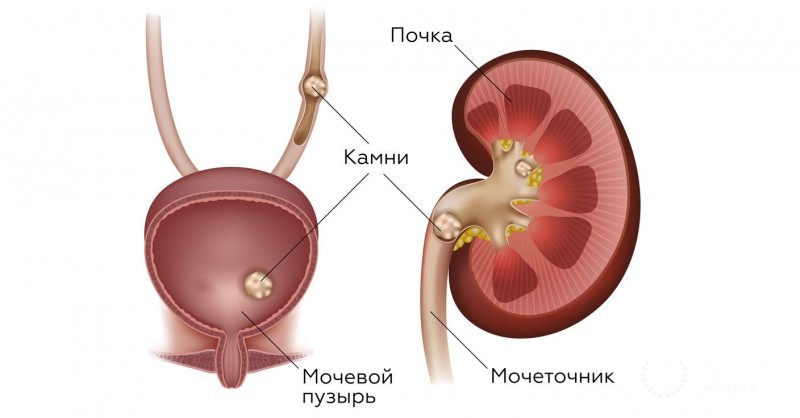 Мочекаменная болезнь