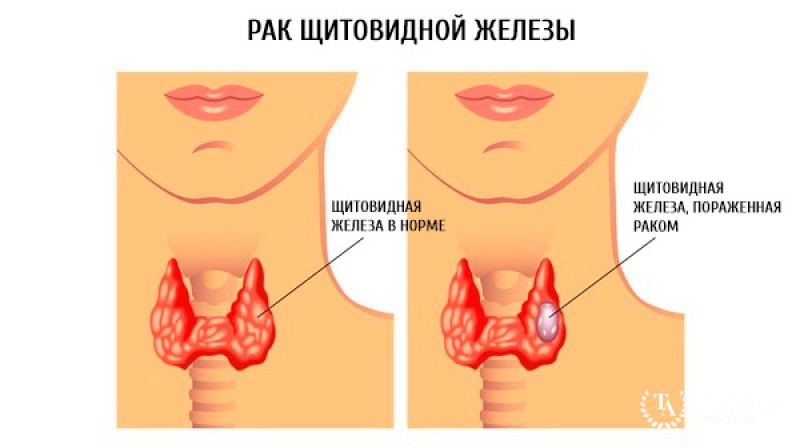 Саркома щитовидной железы