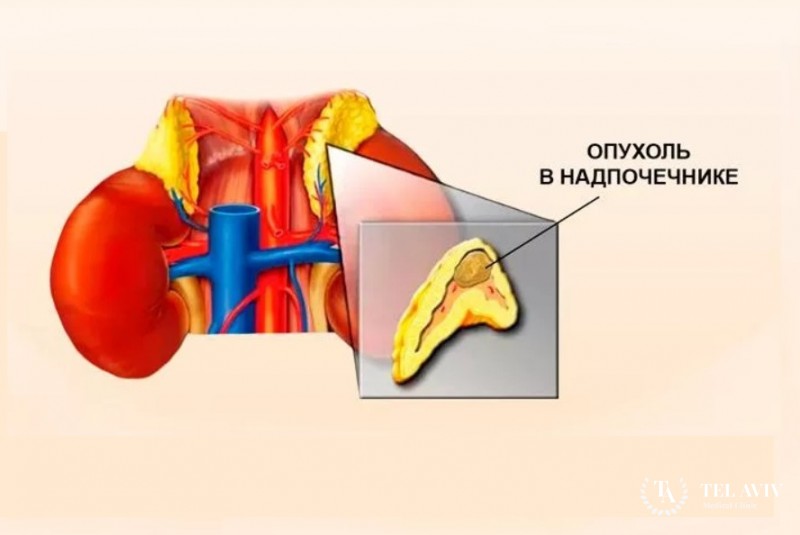 Аденома надпочечников