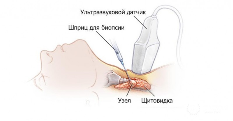 Тонкоигольная аспирационная пункционная биопсия (ТАПБ)