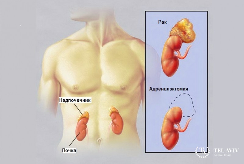 Адреналэктомия лапароскопическим или эндоскопическим методом