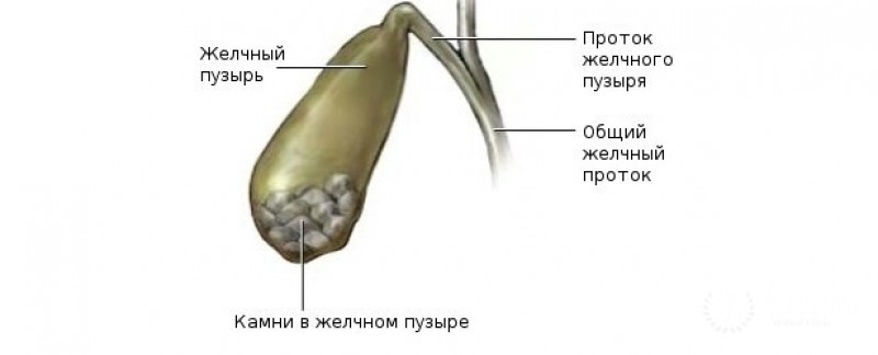 Диагностика и симптоматика холелитиаза