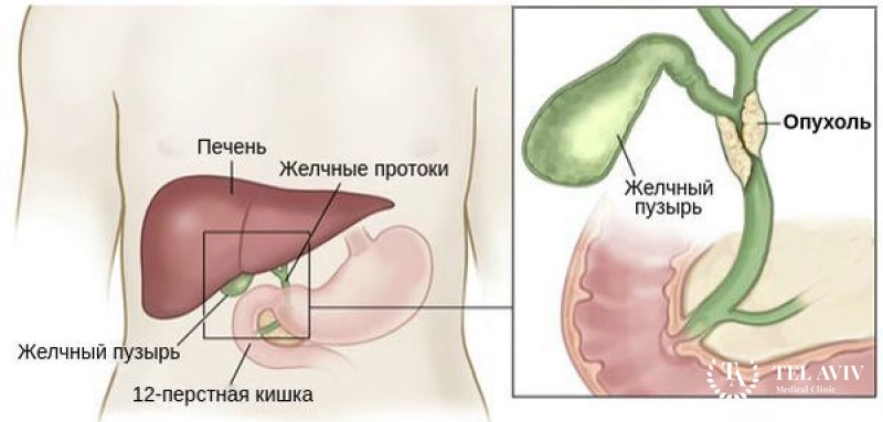 Холангиокарцинома: информация