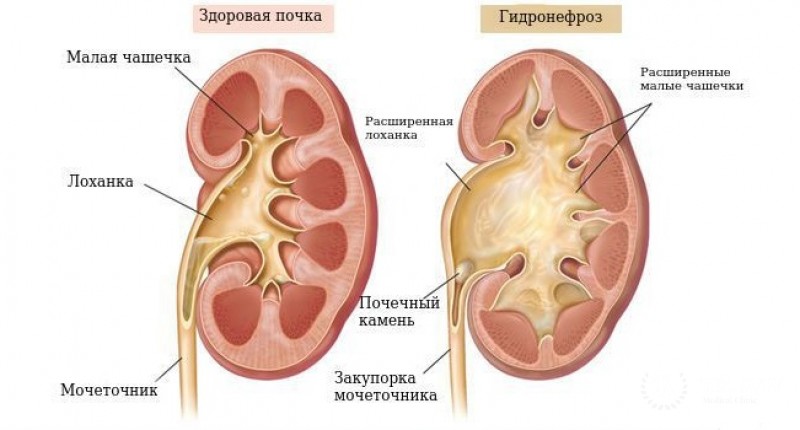 Гидронефроз почки: информация