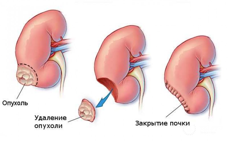 Лапароскопические операции почки: информация