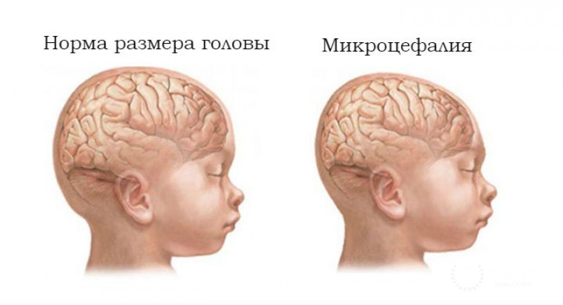 Микроцефалия: вся информация