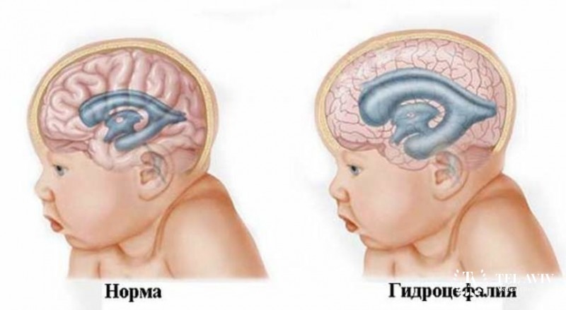 Гидроцефалия (водянка головного мозга) у детей: информация