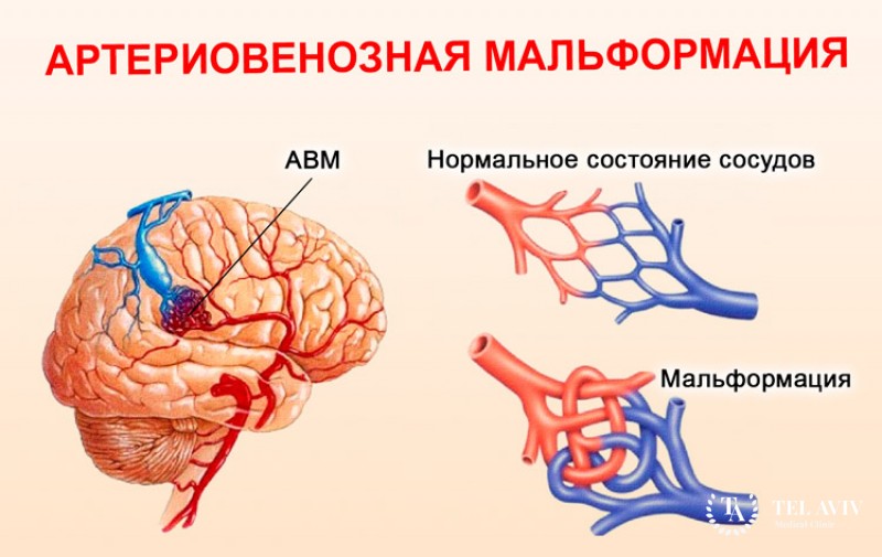 Сосудистые патологии головного мозга у детей: информация