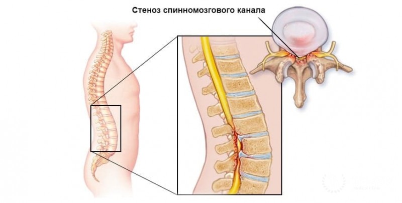 Декомпрессионная ламинэктомия: информация