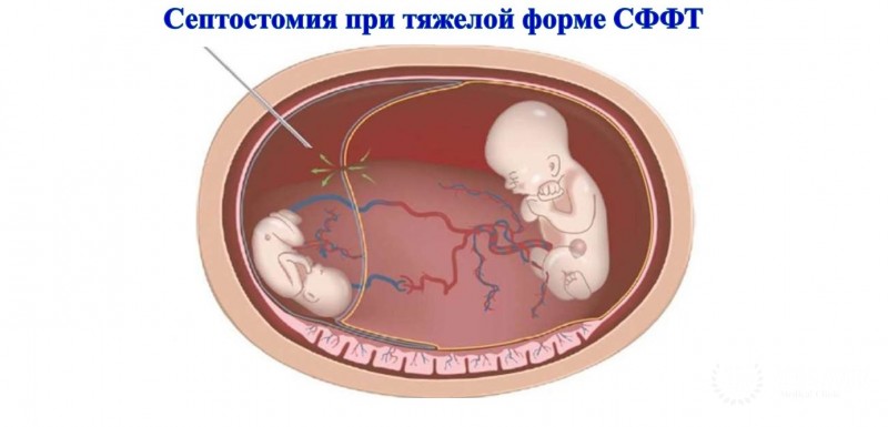 Септостомия: информация