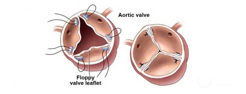 Aortic valve reconstruction