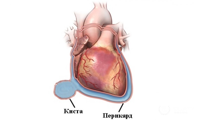 Киста перикарда: информация