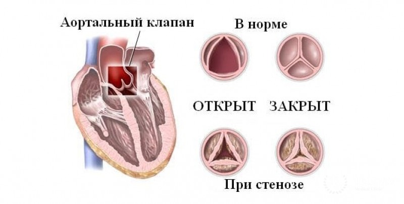 Аортальный стеноз: общая информация