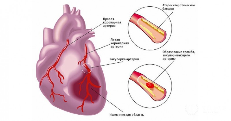 Инфаркт миокарда: общая информация
