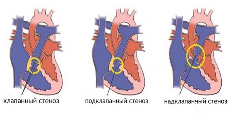 Легочный стеноз: общая информация