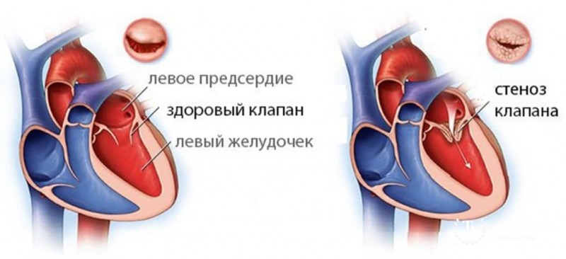 Митральный стеноз: общая информация